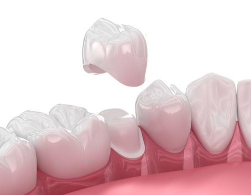 dental crown on tooth