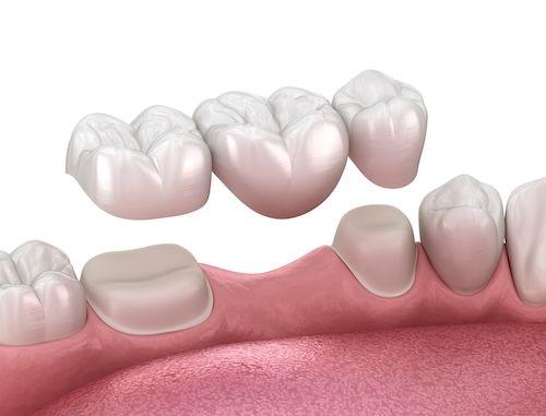 dental bridge illustration