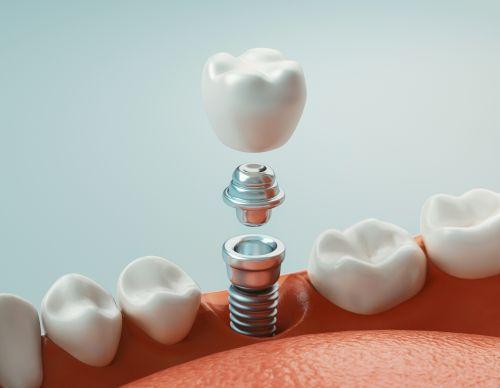 single tooth dental implant