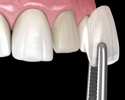 Porcelain Veneers in Madison, AL