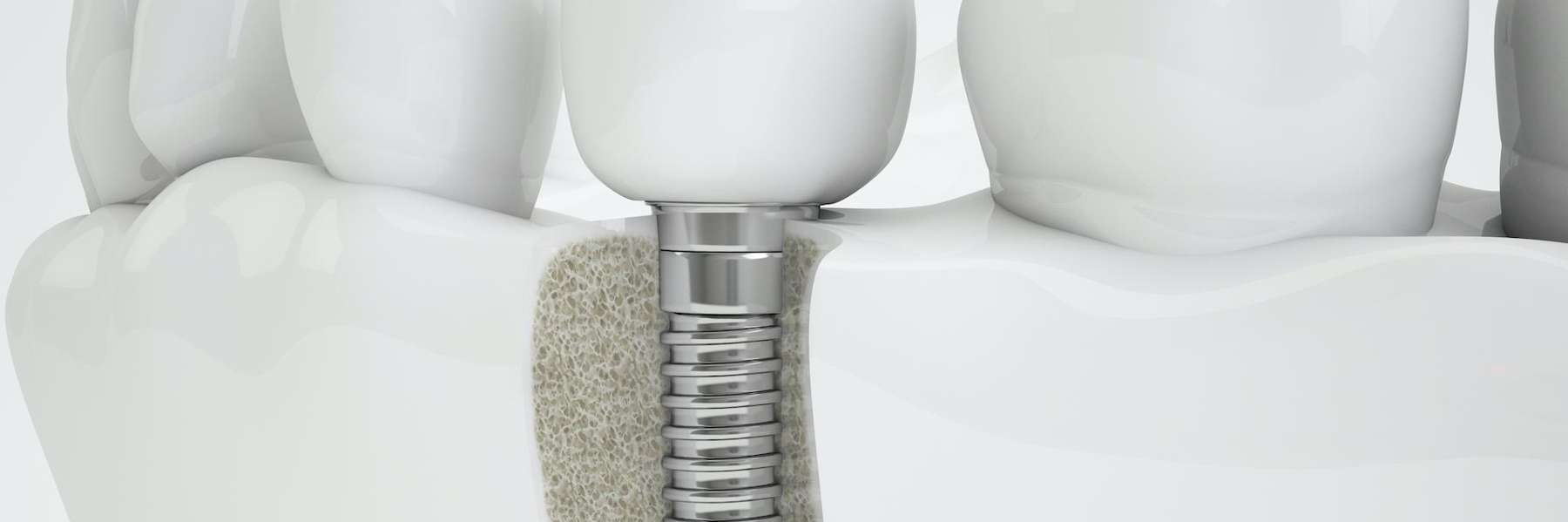 dental implant post