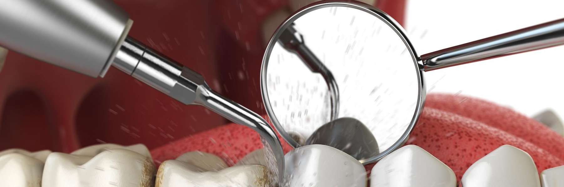 regular dental cleaning in Madison, AL