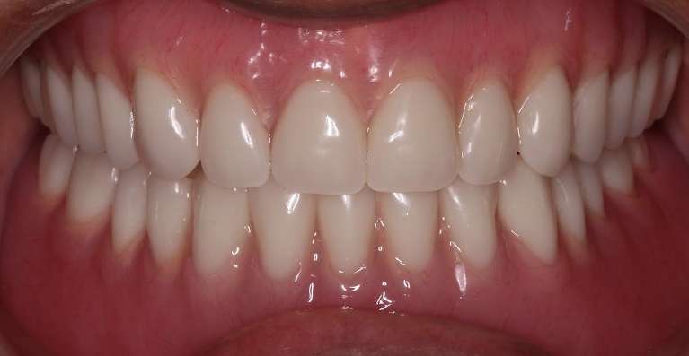 Denture-After-Image