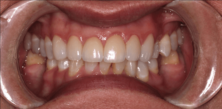 Smile-Makeover-After-Image