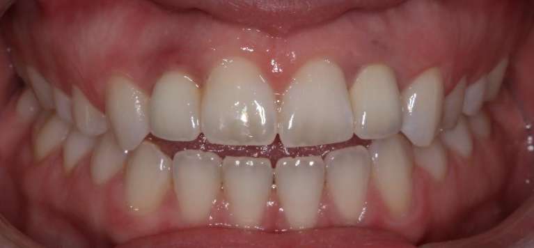 Implant-After-Image
