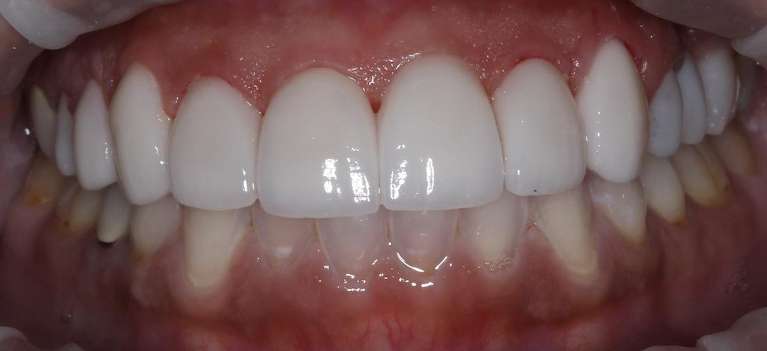 Veneers-After-Image