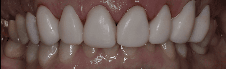 Smile-Makeover-After-Image