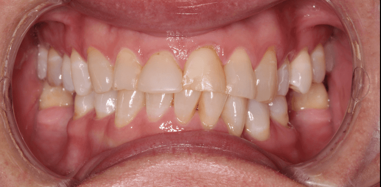 Smile-Makeover-Before-Image