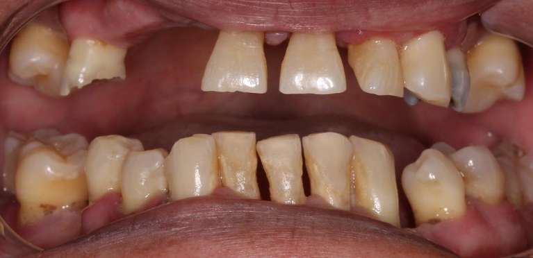 Immediate-Before-Image