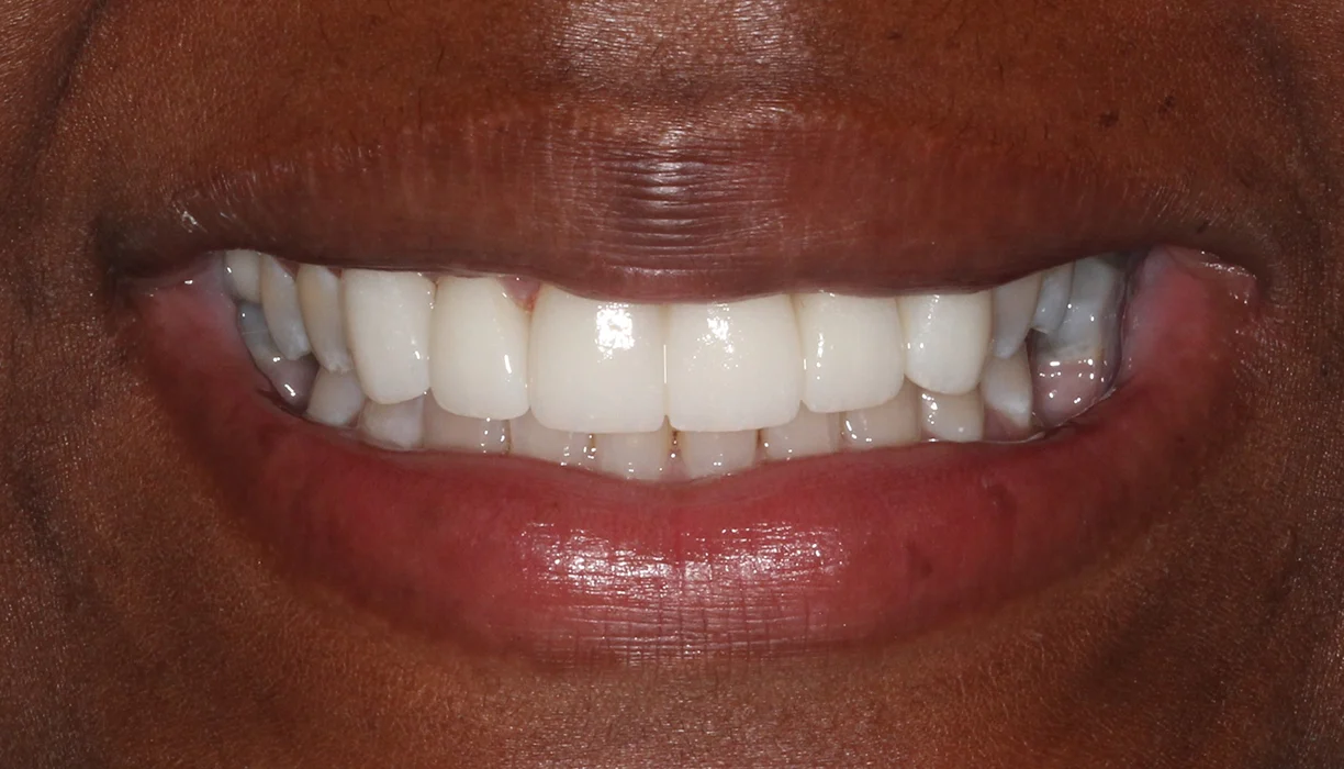 Smile gallery case 1, after treatment: bright, even smile