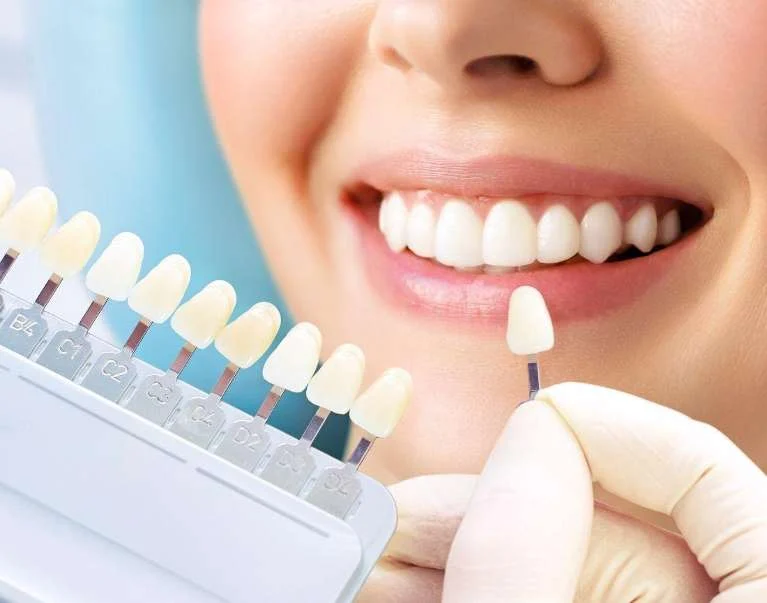Tooth shade guide held next to a woman’s white smile
